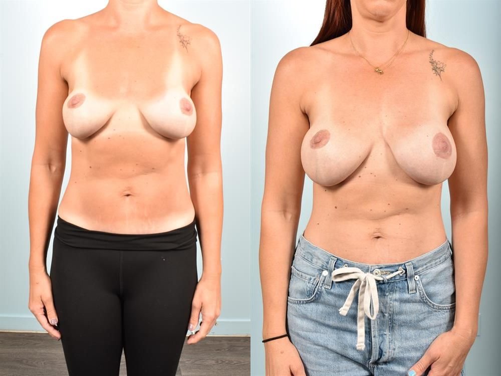 Breast Lift (Mastopexy) 79