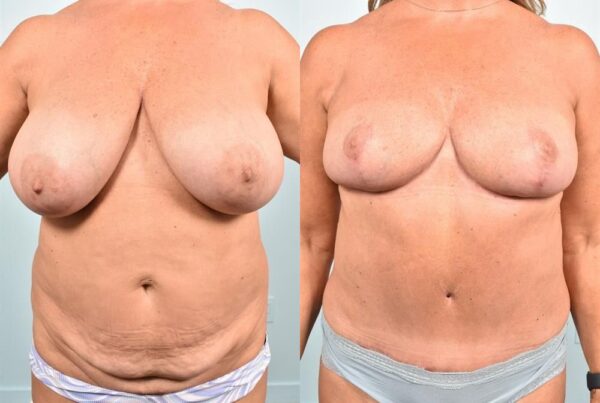 Breast Lift (Mastopexy) 8