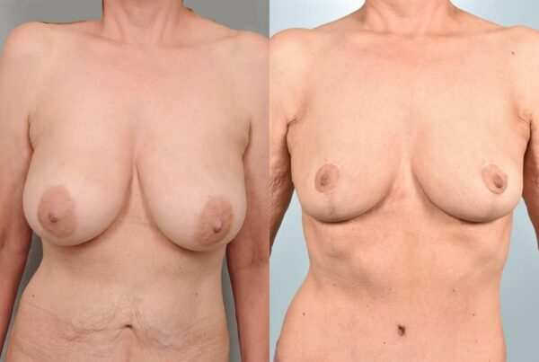 Breast Lift (Mastopexy) 81