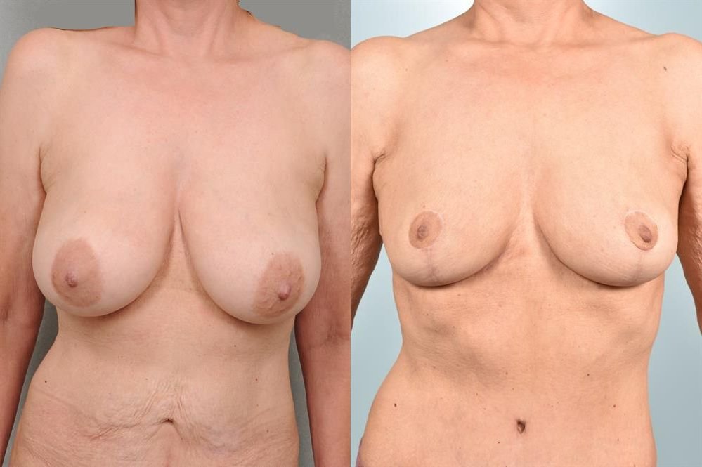 Breast Lift (Mastopexy) 81