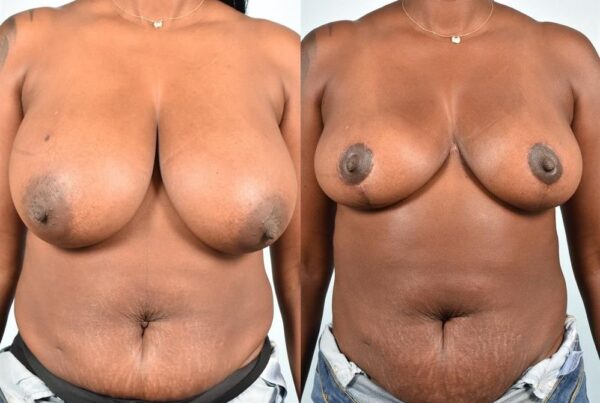 Breast Lift (Mastopexy) 82