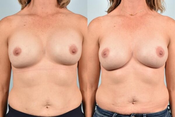 Breast Lift (Mastopexy) 83