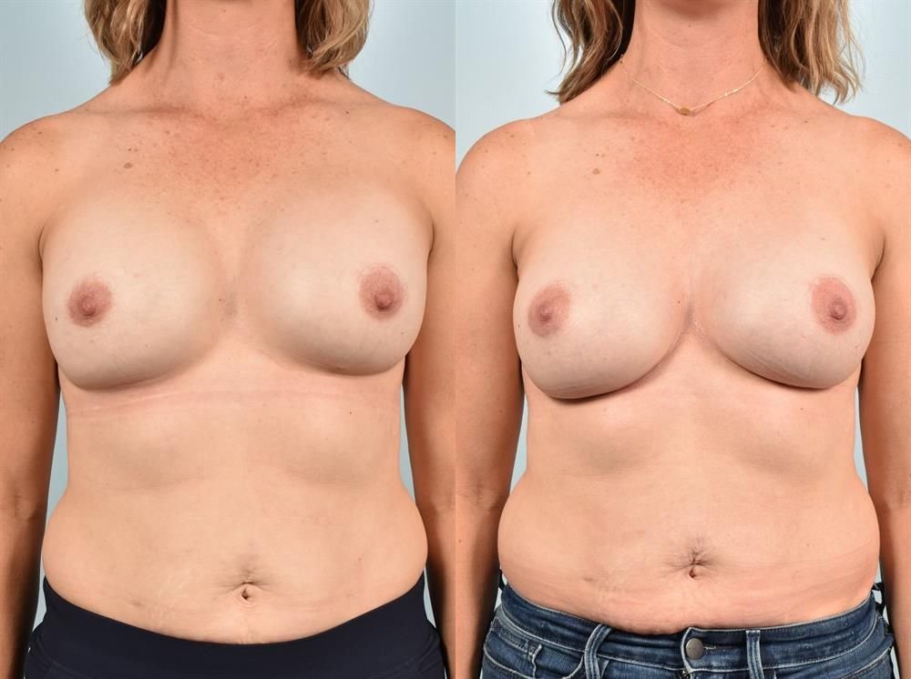 Breast Lift (Mastopexy) 83