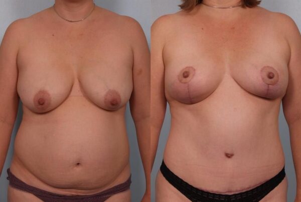 Breast Lift (Mastopexy) 84
