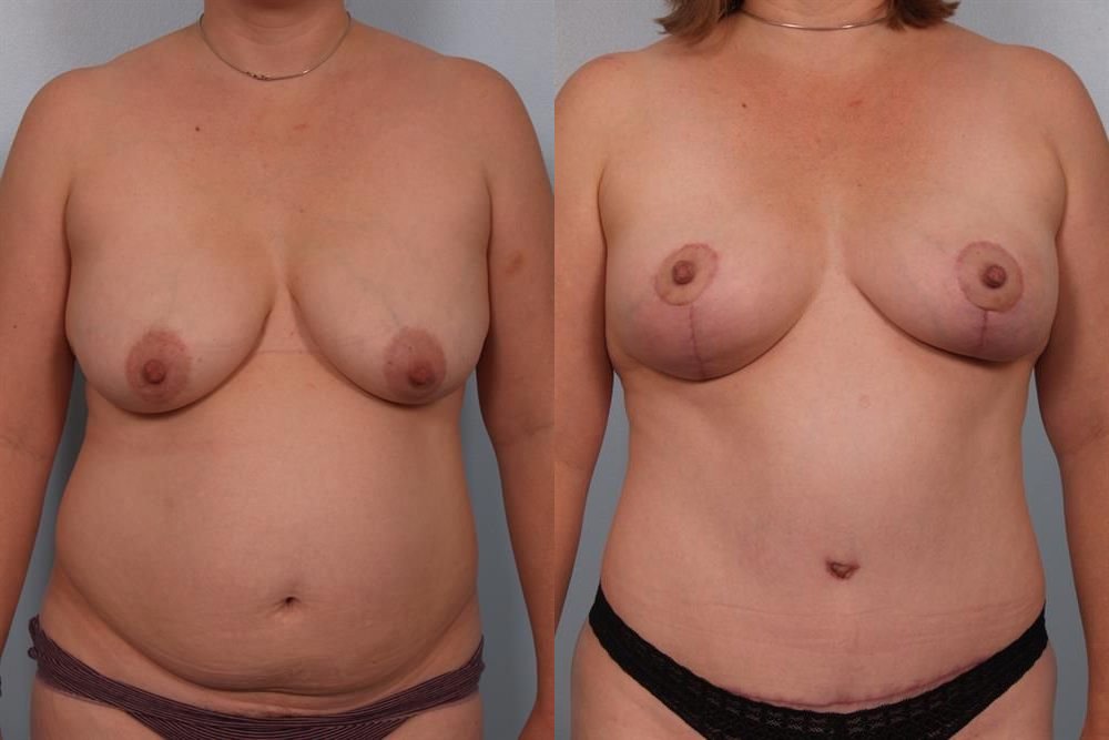 Breast Lift (Mastopexy) 84