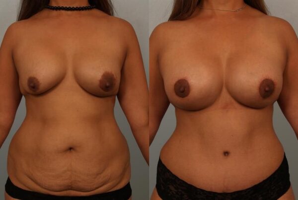 Breast Lift (Mastopexy) 86