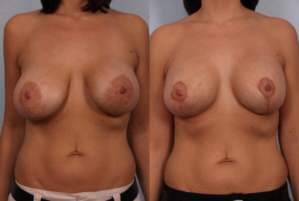 Breast Lift (Mastopexy) 87