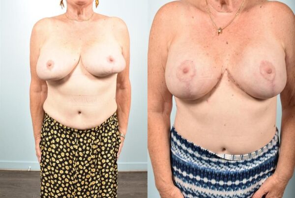Breast Lift (Mastopexy) 88