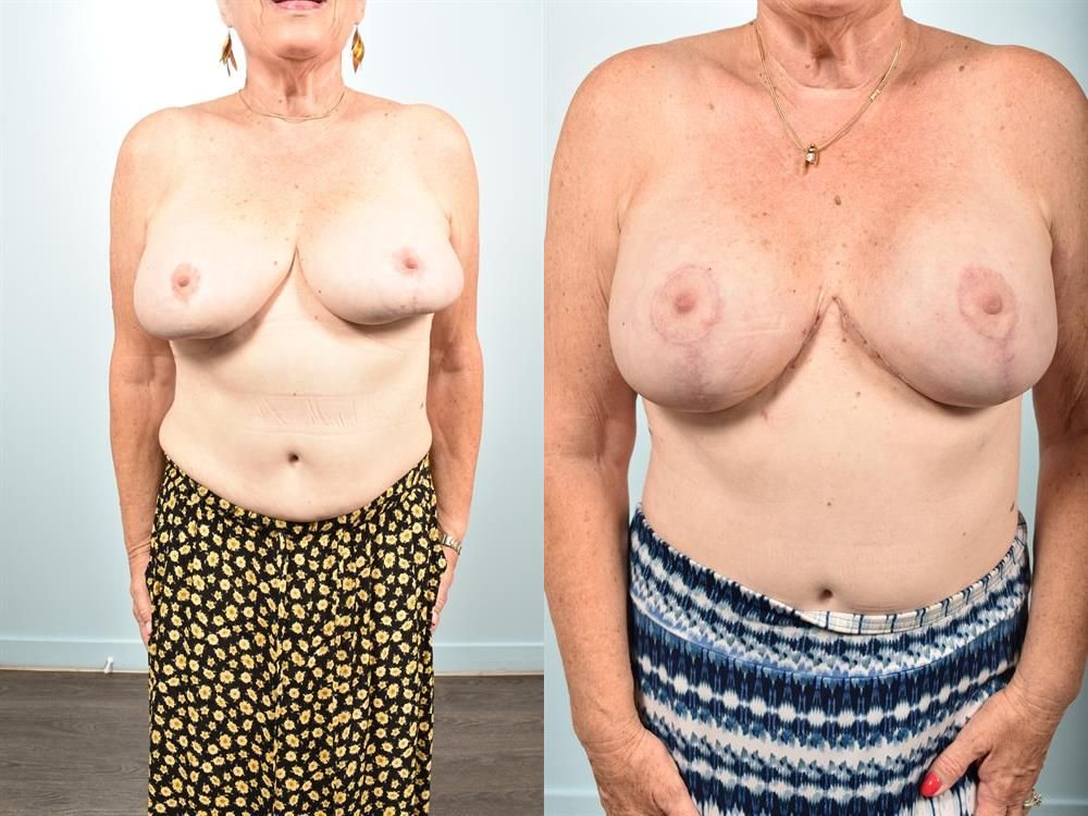 Breast Lift (Mastopexy) 88