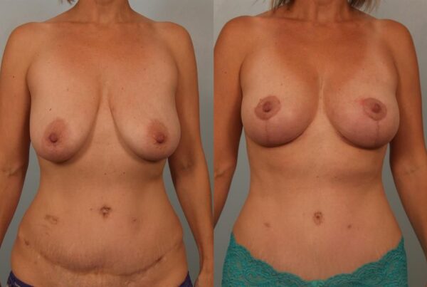 Breast Lift (Mastopexy) 9
