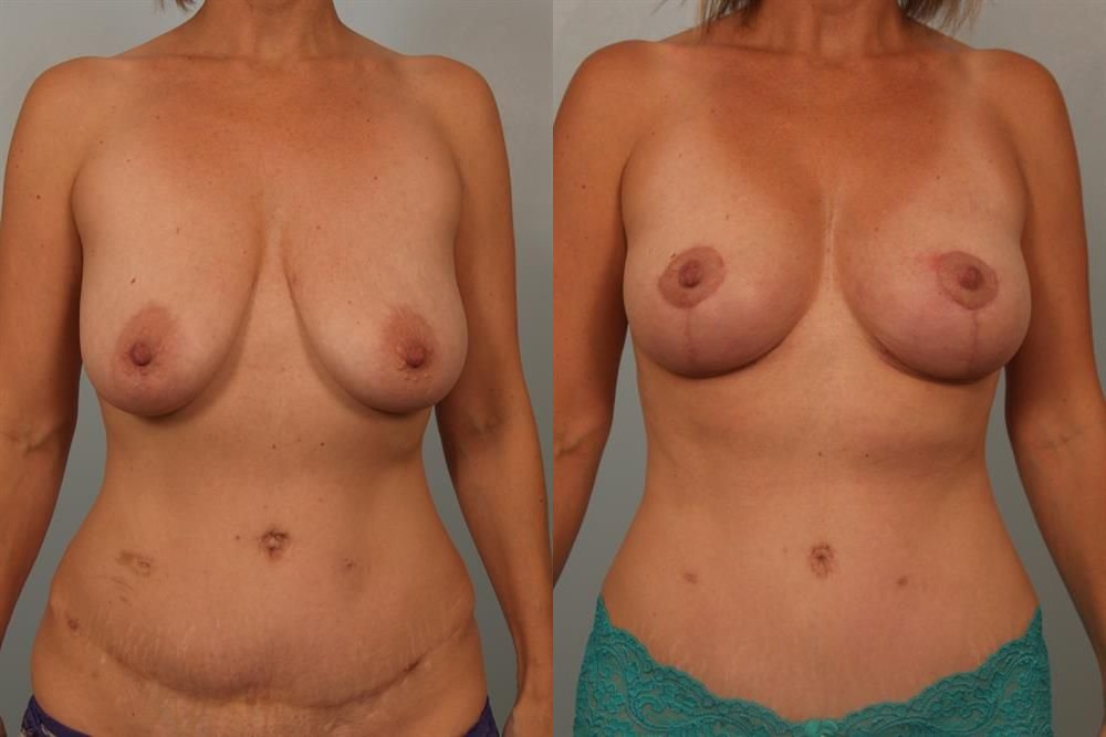 Breast Lift (Mastopexy) 9