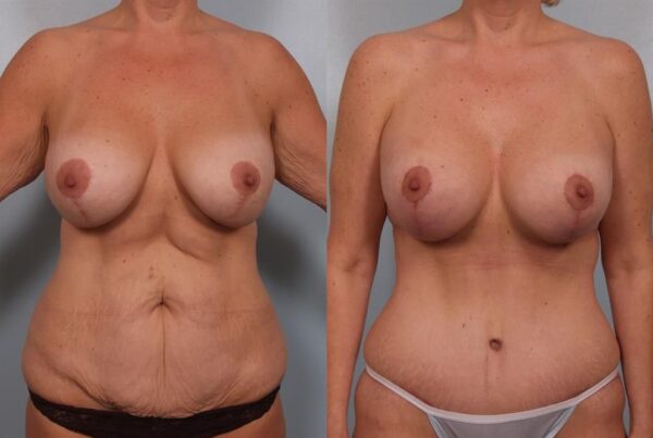 Breast Lift (Mastopexy) 90