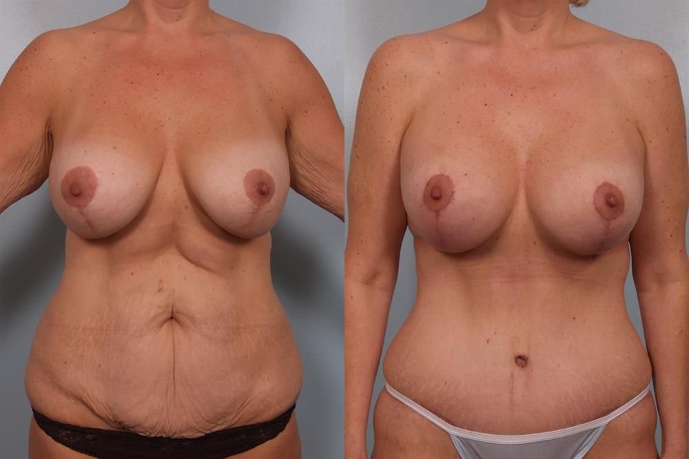 Breast Lift (Mastopexy) 90