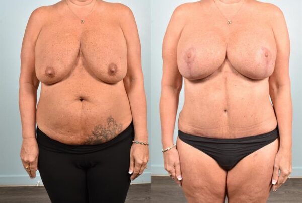 Breast Lift (Mastopexy) 91