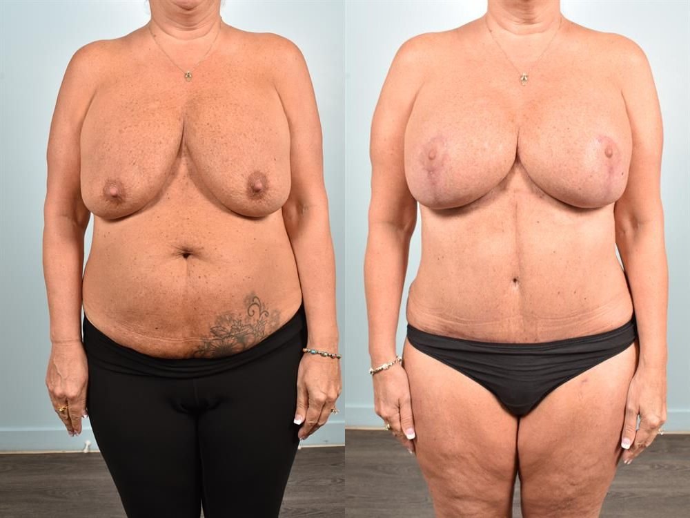 Breast Lift (Mastopexy) 91