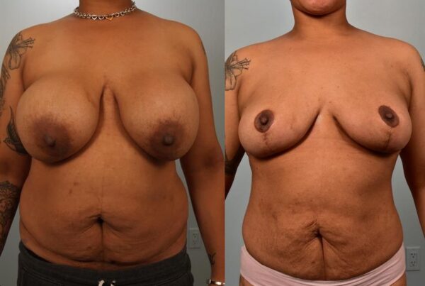 Breast Lift (Mastopexy) 92