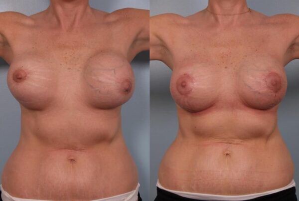 Breast Lift (Mastopexy) 93