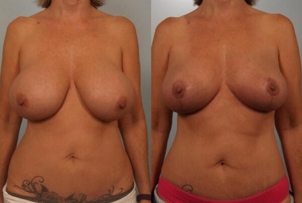 Breast Lift (Mastopexy) 95