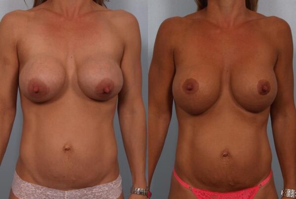 Breast Lift (Mastopexy) 97
