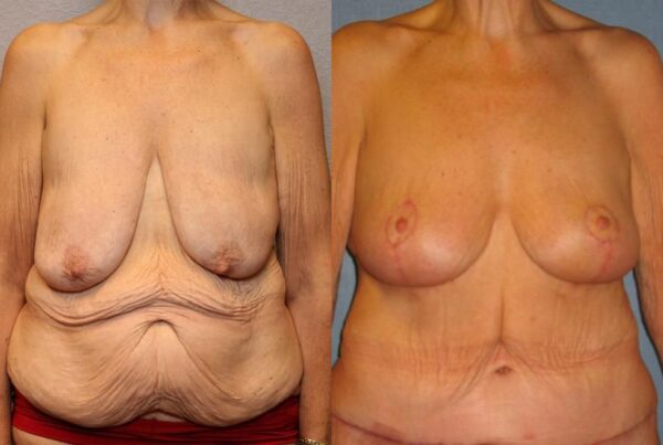 Breast Lift (Mastopexy) 98