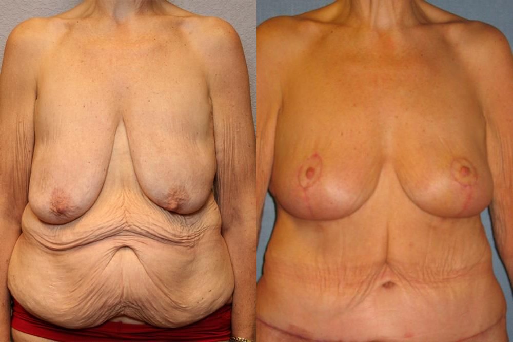 Breast Lift (Mastopexy) 98