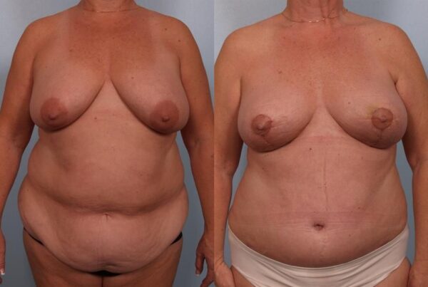 Breast Lift (Mastopexy) 99