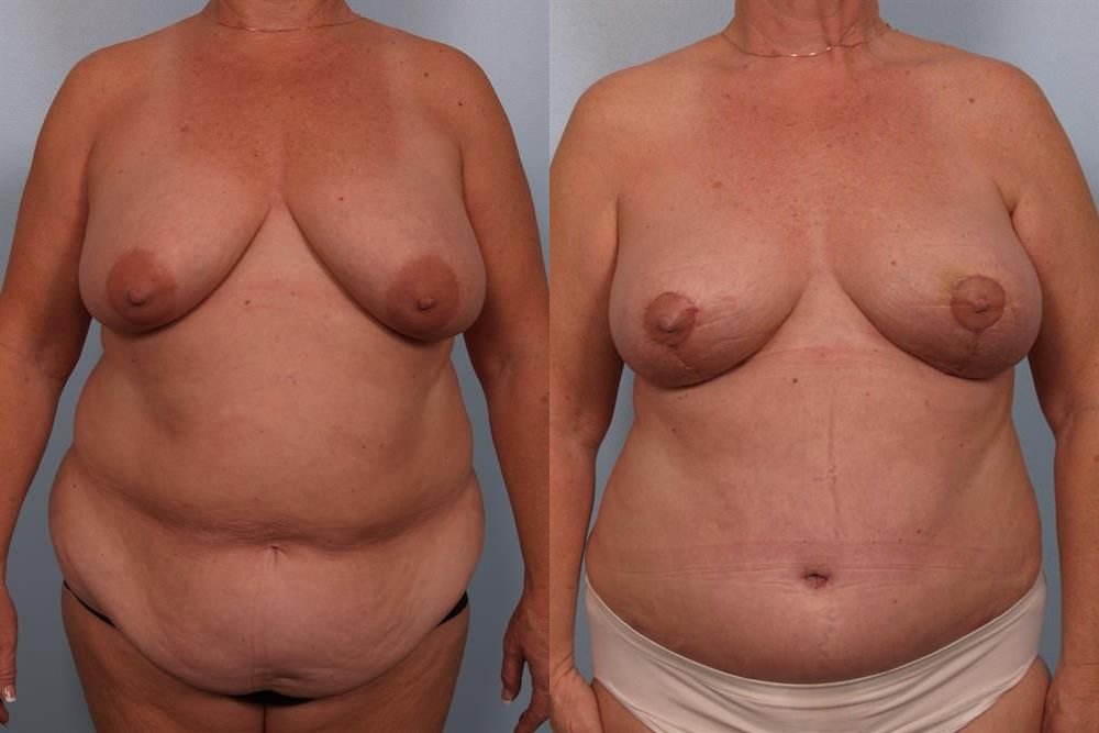 Breast Lift (Mastopexy) 99