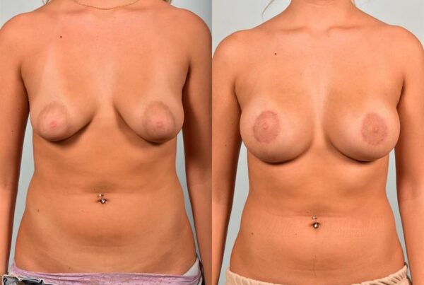 Breast Lift (Mastopexy) with Implants 1