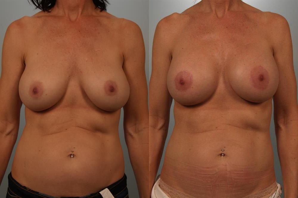 Breast Lift (Mastopexy) with Implants 10