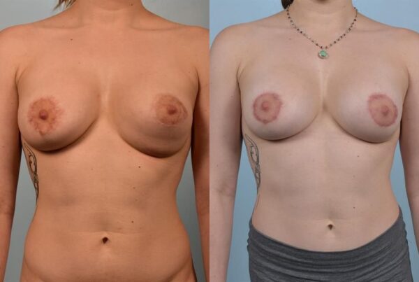 Breast Lift (Mastopexy) with Implants 2