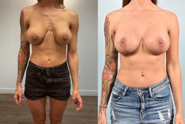 Breast Lift (Mastopexy) with Implants 3