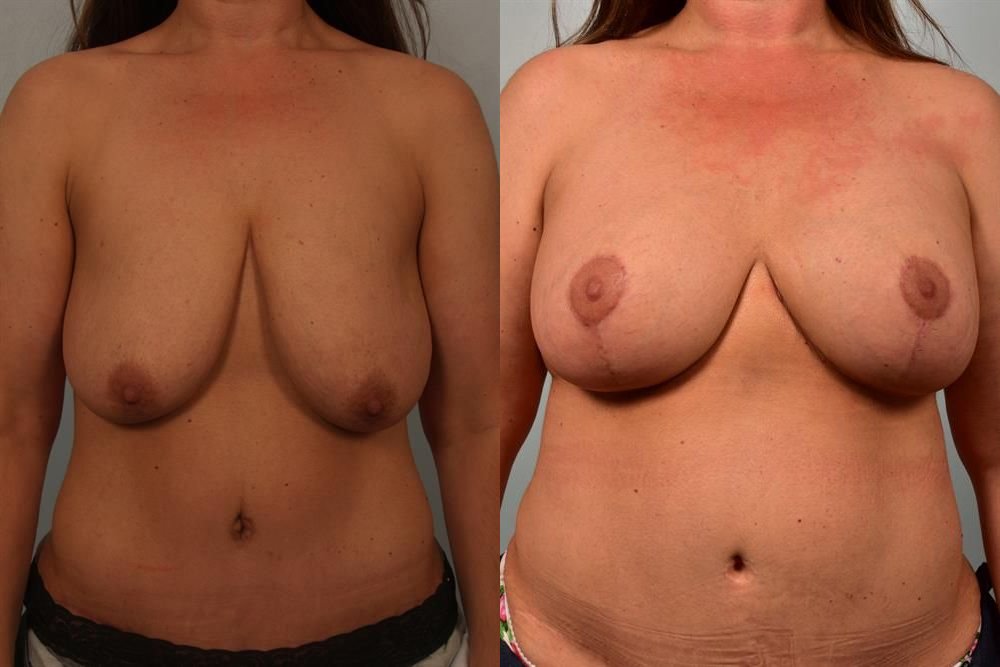 Breast Lift (Mastopexy) with Implants 4