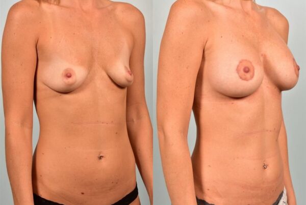 Breast Lift (Mastopexy) with Implants 5