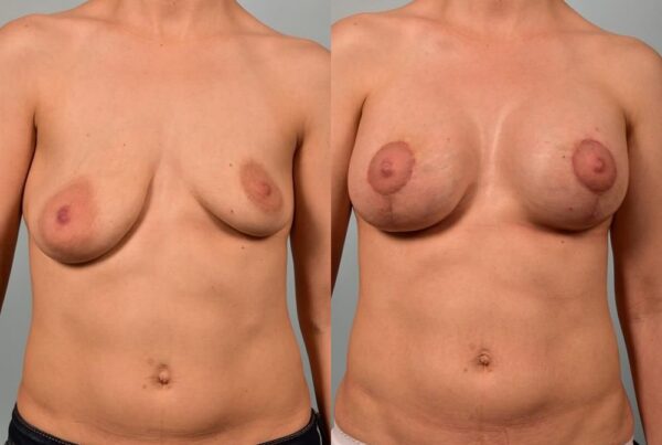 Breast Lift (Mastopexy) with Implants 6