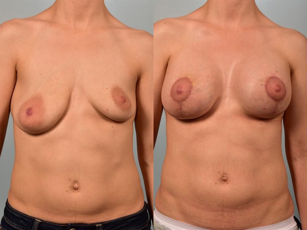 Breast Lift (Mastopexy) with Implants 6