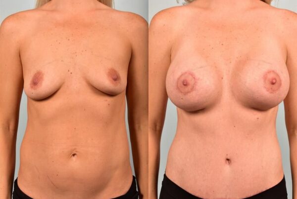 Breast Lift (Mastopexy) with Implants 7