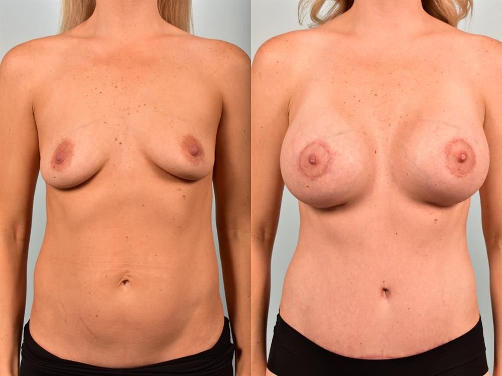 Breast Lift (Mastopexy) with Implants 7