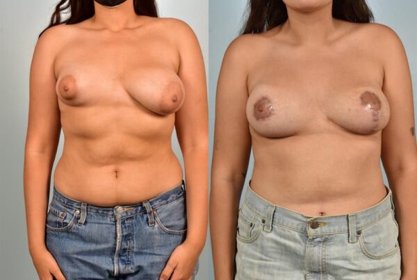Breast Lift (Mastopexy) with Implants 8