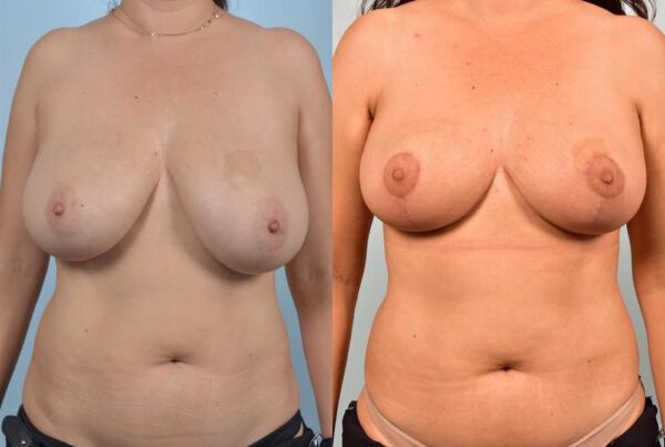 Breast Reduction 1