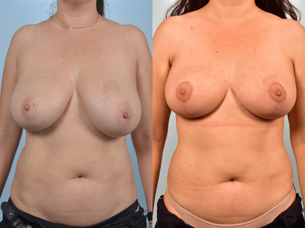 Breast Reduction 1