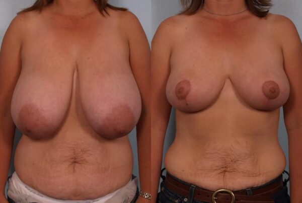 Breast Reduction 10