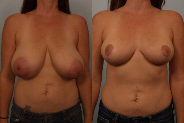 Breast Reduction 11