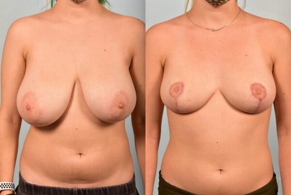 Breast Reduction 13