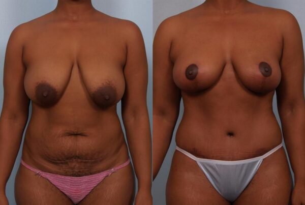 Breast Reduction 14