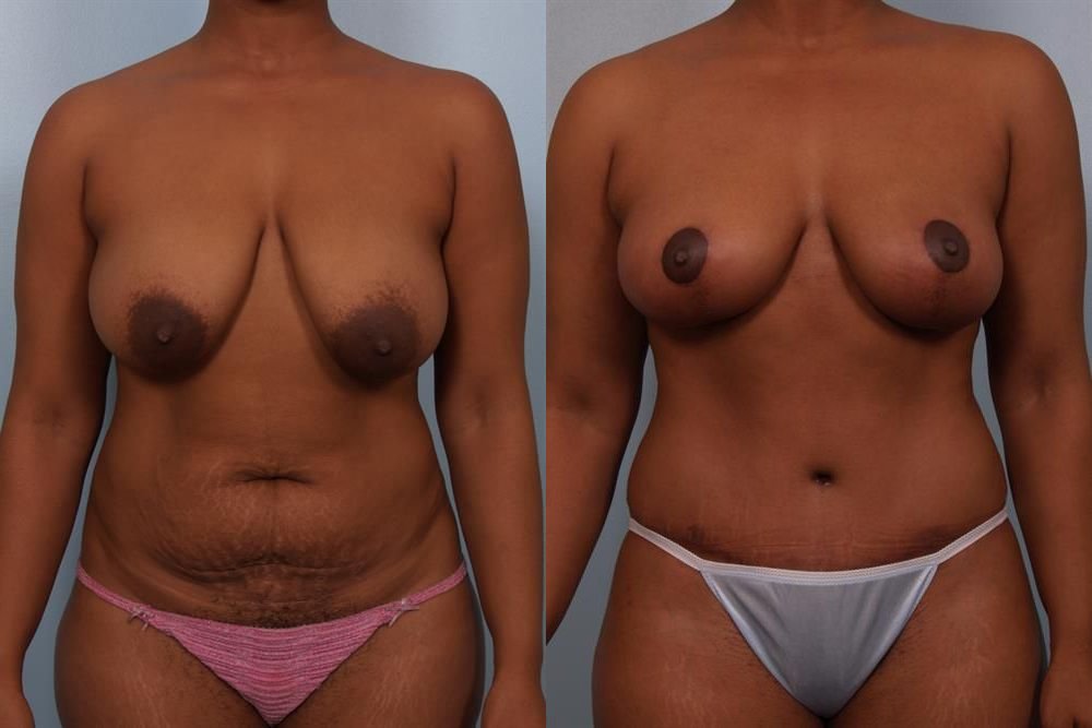 Breast Reduction 14