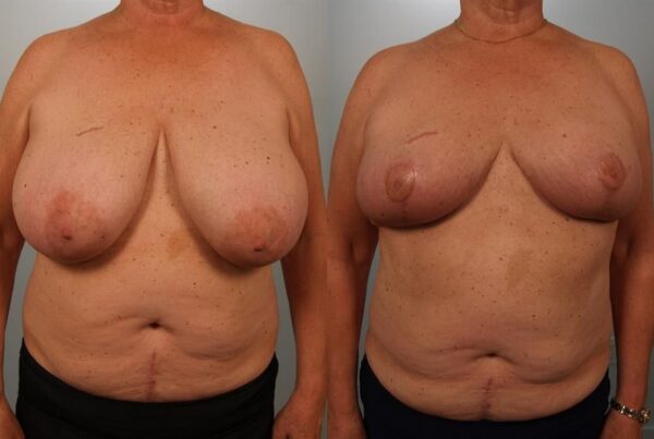 Breast Reduction 15