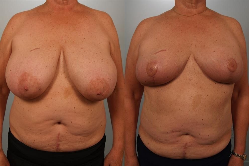 Breast Reduction 15