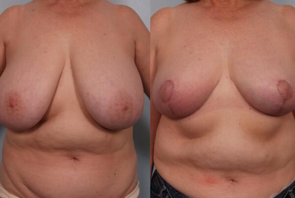 Breast Reduction 16