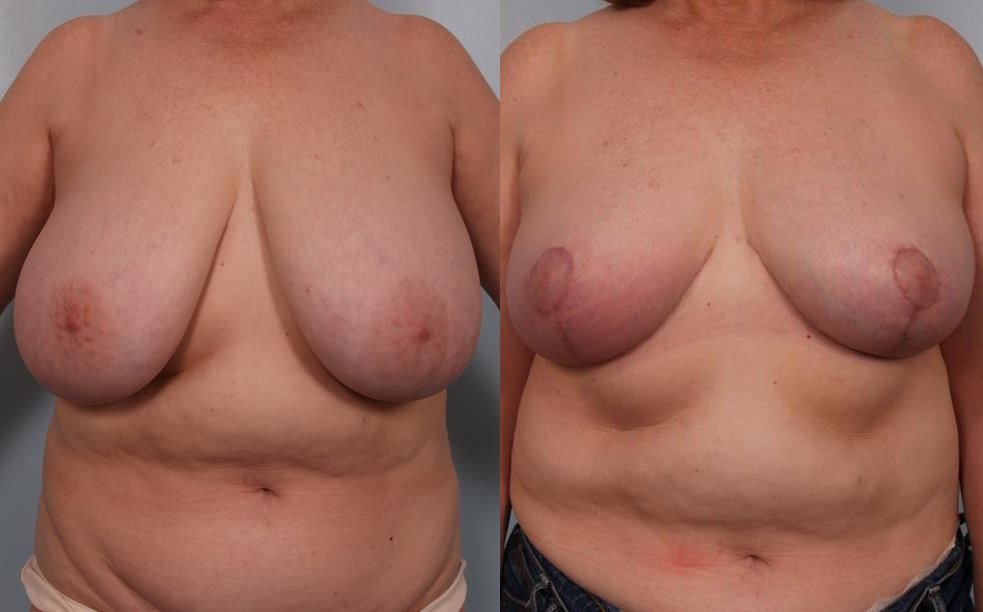 Breast Reduction 16