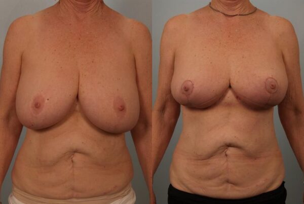 Breast Reduction 17